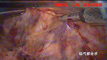 疝气补片怎么固定【腹腔镜篇】疝修补术——疝气的最佳手术方式_https://www.jmylbn.com_新闻资讯_第8张