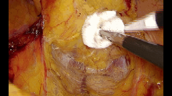 纱布怎么止血手术室不可缺少的耗材，速即纱的妙用_https://www.jmylbn.com_新闻资讯_第6张