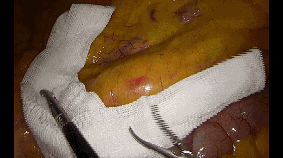 纱布怎么止血手术室不可缺少的耗材，速即纱的妙用_https://www.jmylbn.com_新闻资讯_第4张