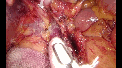 纱布怎么止血手术室不可缺少的耗材，速即纱的妙用_https://www.jmylbn.com_新闻资讯_第8张