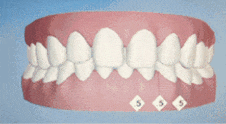 关于牙齿矫正的N个谣言，你信过哪个？