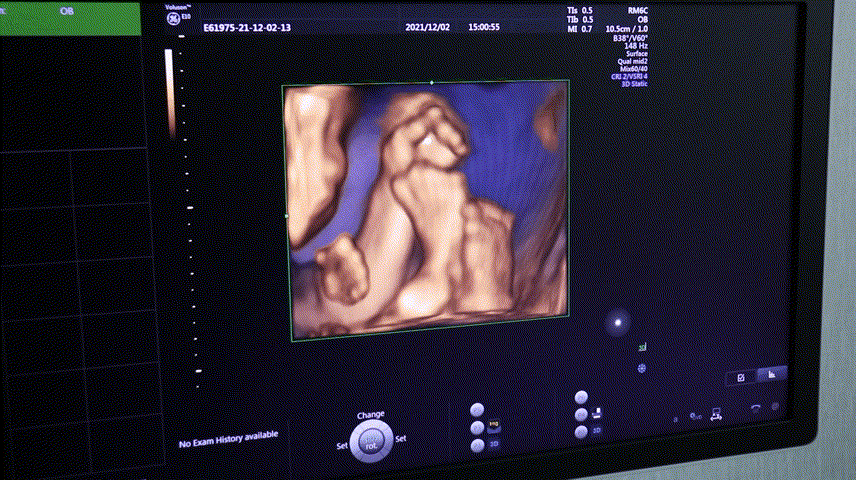 汕头彩超怎么样四维小科普 4 问 4 答，你不清楚的都在这篇推文里！『汕头市妇产医院』_https://www.jmylbn.com_新闻资讯_第5张