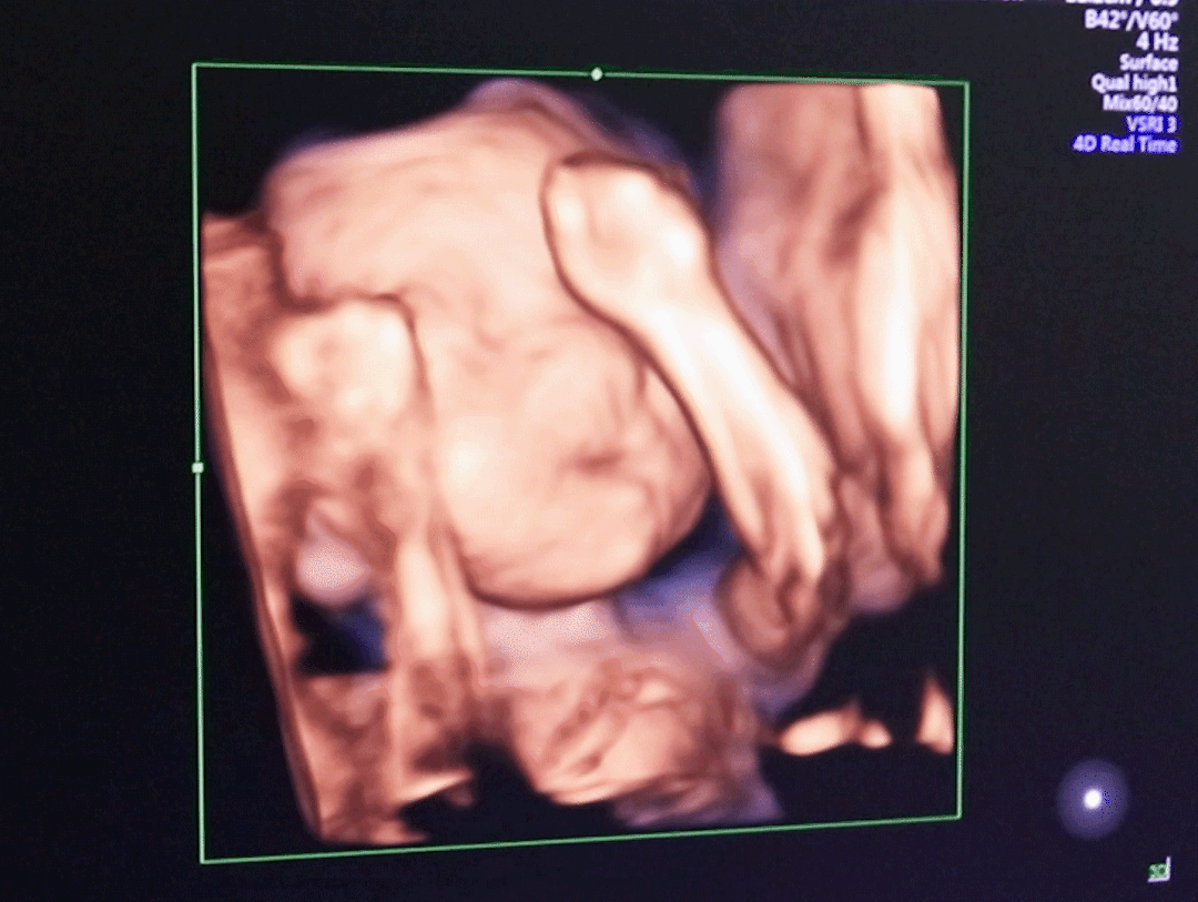 汕头彩超怎么样四维小科普 4 问 4 答，你不清楚的都在这篇推文里！『汕头市妇产医院』_https://www.jmylbn.com_新闻资讯_第14张