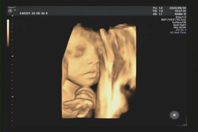 汕头彩超怎么样四维小科普 4 问 4 答，你不清楚的都在这篇推文里！『汕头市妇产医院』_https://www.jmylbn.com_新闻资讯_第7张