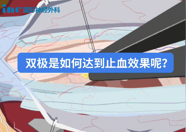 双极电凝为什么要冲水神外科普系列｜2分钟动画解读：什么是双极电凝？有什么作用？_https://www.jmylbn.com_新闻资讯_第10张
