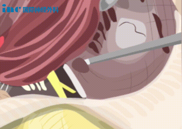 双极电凝为什么要冲水神外科普系列｜2分钟动画解读：什么是双极电凝？有什么作用？_https://www.jmylbn.com_新闻资讯_第14张