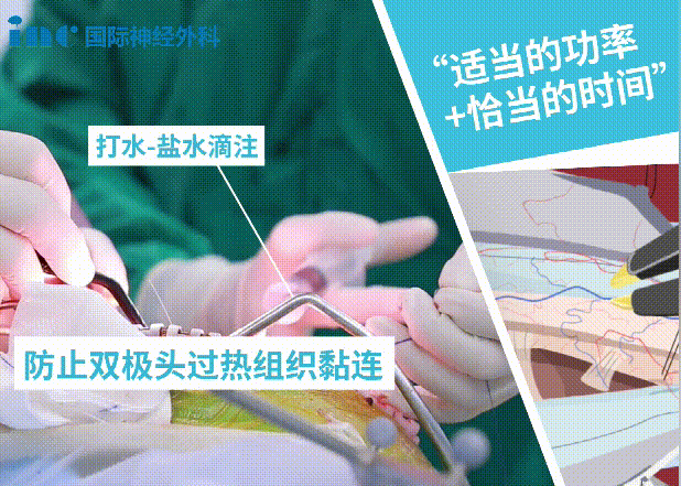 双极电凝为什么要冲水神外科普系列｜2分钟动画解读：什么是双极电凝？有什么作用？_https://www.jmylbn.com_新闻资讯_第12张