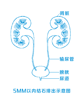 输尿管结石疼起来真要命!四川结石病医院专家教你正确防治方法!(图2) 图片