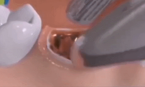 止血海绵是什么一块海绵几十元？说说拔牙窝里塞的明胶海绵_https://www.jmylbn.com_新闻资讯_第8张