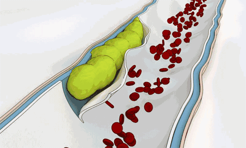 “三高”相互勾结太可怕啦！现在知道还不算晚（内附降血脂穴位图）