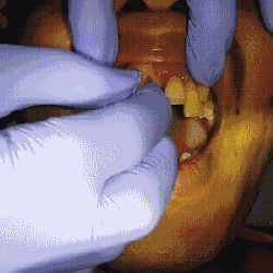 慎点！！牙周炎竟会严重到这个程度......