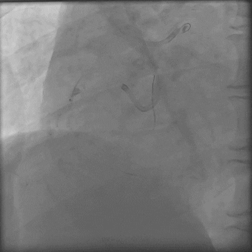 导丝怎么扩秦川论剑｜张勇：攻坚克难——解决器械难以通过的CTO病变之技术图谱_https://www.jmylbn.com_新闻资讯_第25张