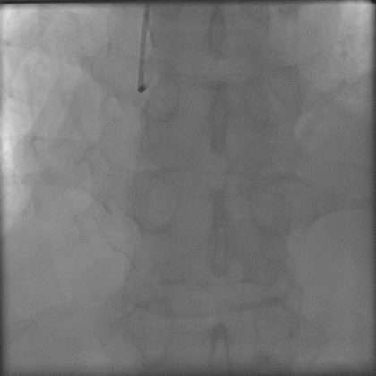 导丝怎么扩秦川论剑｜张勇：攻坚克难——解决器械难以通过的CTO病变之技术图谱_https://www.jmylbn.com_新闻资讯_第15张