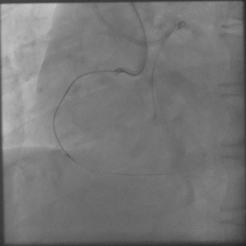 导丝怎么扩秦川论剑｜张勇：攻坚克难——解决器械难以通过的CTO病变之技术图谱_https://www.jmylbn.com_新闻资讯_第26张