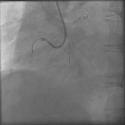 导丝怎么扩秦川论剑｜张勇：攻坚克难——解决器械难以通过的CTO病变之技术图谱_https://www.jmylbn.com_新闻资讯_第19张