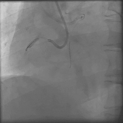 导丝怎么扩秦川论剑｜张勇：攻坚克难——解决器械难以通过的CTO病变之技术图谱_https://www.jmylbn.com_新闻资讯_第20张