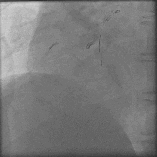 导丝怎么扩秦川论剑｜张勇：攻坚克难——解决器械难以通过的CTO病变之技术图谱_https://www.jmylbn.com_新闻资讯_第24张