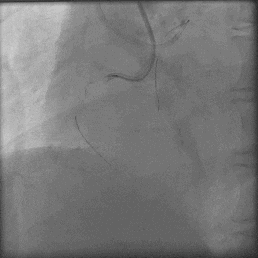 导丝怎么扩秦川论剑｜张勇：攻坚克难——解决器械难以通过的CTO病变之技术图谱_https://www.jmylbn.com_新闻资讯_第16张
