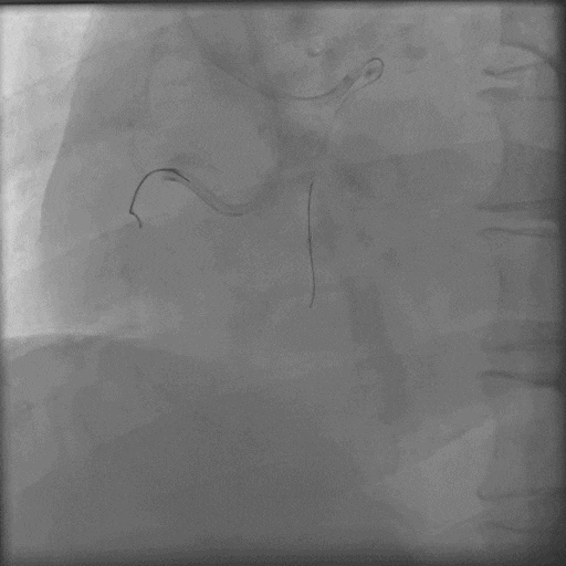 导丝怎么扩秦川论剑｜张勇：攻坚克难——解决器械难以通过的CTO病变之技术图谱_https://www.jmylbn.com_新闻资讯_第21张