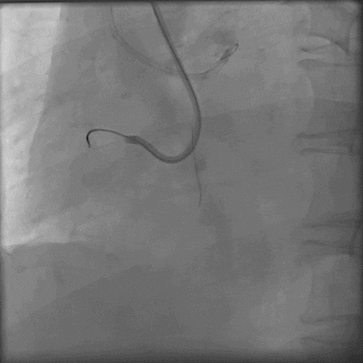 导丝怎么扩秦川论剑｜张勇：攻坚克难——解决器械难以通过的CTO病变之技术图谱_https://www.jmylbn.com_新闻资讯_第17张