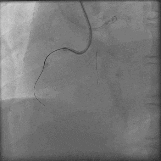 导丝怎么扩秦川论剑｜张勇：攻坚克难——解决器械难以通过的CTO病变之技术图谱_https://www.jmylbn.com_新闻资讯_第22张