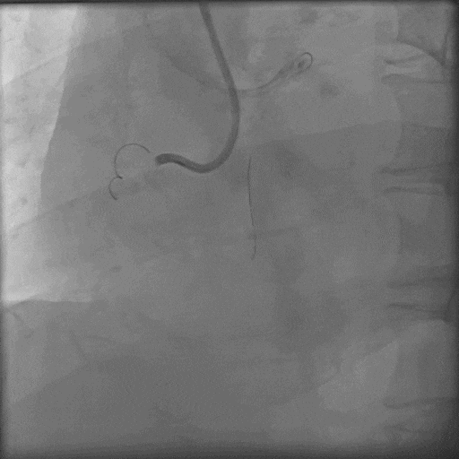 导丝怎么扩秦川论剑｜张勇：攻坚克难——解决器械难以通过的CTO病变之技术图谱_https://www.jmylbn.com_新闻资讯_第18张