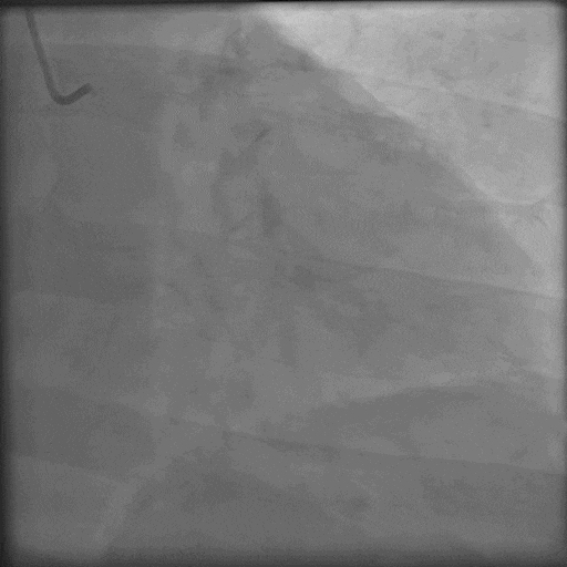 导丝怎么扩秦川论剑｜张勇：攻坚克难——解决器械难以通过的CTO病变之技术图谱_https://www.jmylbn.com_新闻资讯_第11张