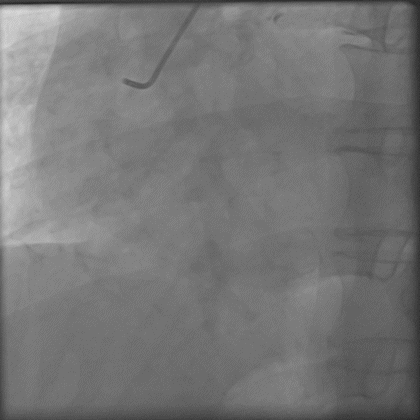 导丝怎么扩秦川论剑｜张勇：攻坚克难——解决器械难以通过的CTO病变之技术图谱_https://www.jmylbn.com_新闻资讯_第14张
