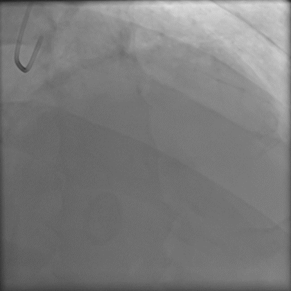 导丝怎么扩秦川论剑｜张勇：攻坚克难——解决器械难以通过的CTO病变之技术图谱_https://www.jmylbn.com_新闻资讯_第10张