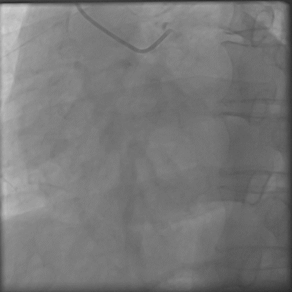 导丝怎么扩秦川论剑｜张勇：攻坚克难——解决器械难以通过的CTO病变之技术图谱_https://www.jmylbn.com_新闻资讯_第13张