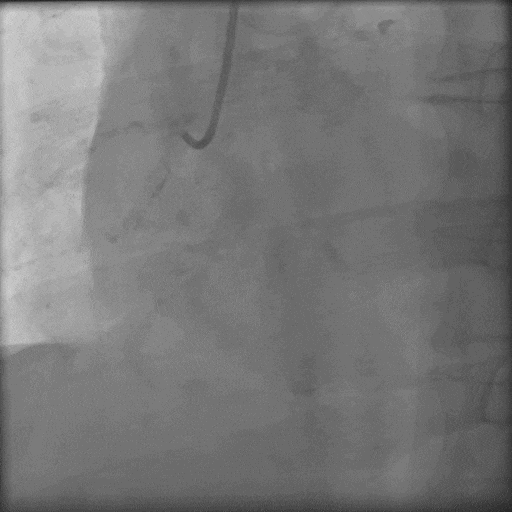 导丝怎么扩秦川论剑｜张勇：攻坚克难——解决器械难以通过的CTO病变之技术图谱_https://www.jmylbn.com_新闻资讯_第27张