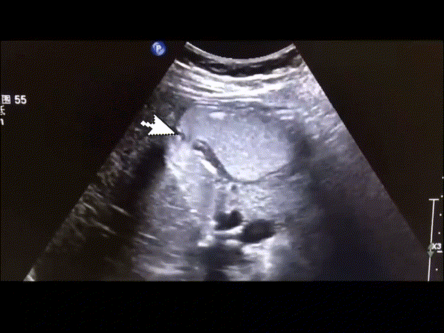 胃造影用的是什么机子胃肠超声造影--无创、无痛、无辐射！_https://www.jmylbn.com_新闻资讯_第20张