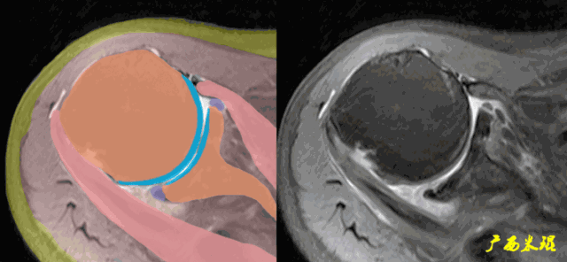 肩关节MRI解剖肩袖损伤诊断技巧--对应动图，效果超赞