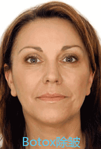 面部的动态纹主要有鱼尾纹,眉间纹,抬头纹,鼻背纹,口周纹等.