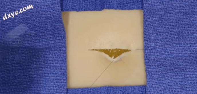 皮下缝合用什么线皮下缝合_https://www.jmylbn.com_新闻资讯_第4张