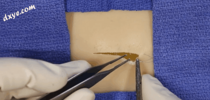 皮下缝合用什么线皮下缝合_https://www.jmylbn.com_新闻资讯_第2张