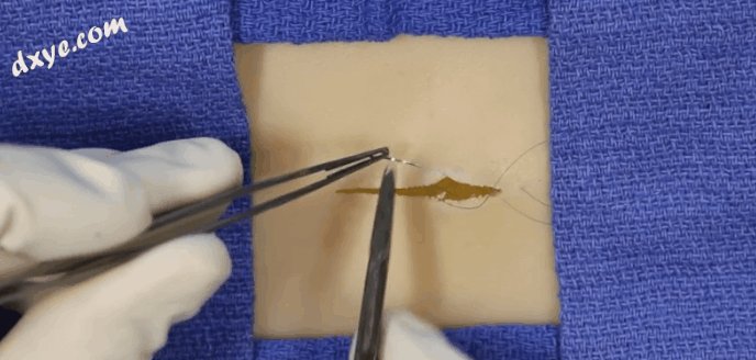 皮下缝合用什么线皮下缝合_https://www.jmylbn.com_新闻资讯_第3张