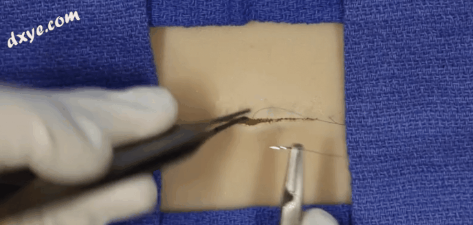 皮下缝合用什么线皮下缝合_https://www.jmylbn.com_新闻资讯_第5张