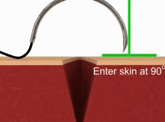 医疗缝线怎么做动图+视频，详解常见手术切口缝合技术_https://www.jmylbn.com_新闻资讯_第7张
