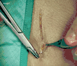 医疗缝线怎么做动图+视频，详解常见手术切口缝合技术_https://www.jmylbn.com_新闻资讯_第22张