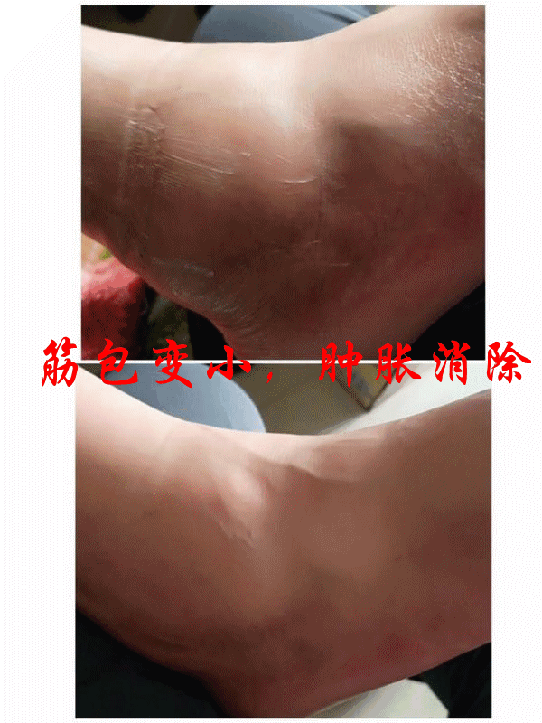 4,徒手治疗人体大小筋包,筋钙化点,筋结,运用家传手法理筋化结散结