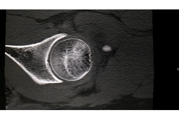 牵引床怎么用视频详解：如何不使用牵引床做好一台股骨颈骨折？_https://www.jmylbn.com_新闻资讯_第6张