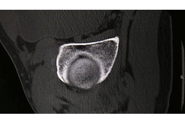 牵引床怎么用视频详解：如何不使用牵引床做好一台股骨颈骨折？_https://www.jmylbn.com_新闻资讯_第4张