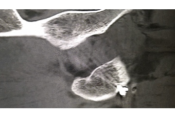 牵引床怎么用视频详解：如何不使用牵引床做好一台股骨颈骨折？_https://www.jmylbn.com_新闻资讯_第24张