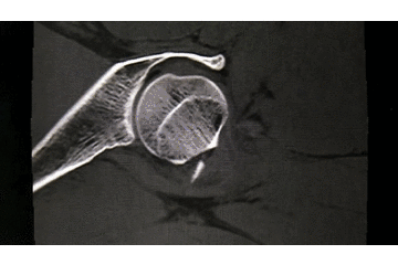 牵引床怎么用视频详解：如何不使用牵引床做好一台股骨颈骨折？_https://www.jmylbn.com_新闻资讯_第5张