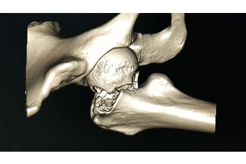 牵引床怎么用视频详解：如何不使用牵引床做好一台股骨颈骨折？_https://www.jmylbn.com_新闻资讯_第7张