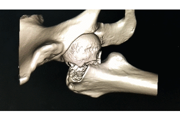 牵引床怎么用视频详解：如何不使用牵引床做好一台股骨颈骨折？_https://www.jmylbn.com_新闻资讯_第8张