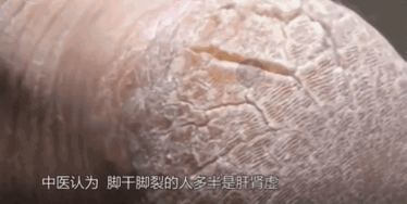 脚后跟经常干裂、出血,走路都疼!抹润肤霜不管用,这招才对症!