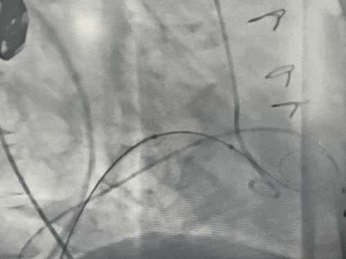 导丝怎么扩挑战高龄高危极限，引领微创“心”突破！大医二院赵昕教授团队使用Renatus®球扩瓣成功完成一例高难度经导管二尖瓣瓣中瓣置换术_https://www.jmylbn.com_新闻资讯_第8张