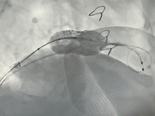 导丝怎么扩挑战高龄高危极限，引领微创“心”突破！大医二院赵昕教授团队使用Renatus®球扩瓣成功完成一例高难度经导管二尖瓣瓣中瓣置换术_https://www.jmylbn.com_新闻资讯_第10张